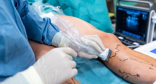Cirujanos vasculares - Médico experto en angiología realizando un tratamiento para las varices reconocido como uno de los mejores cirujanos vasculares en Madrid
