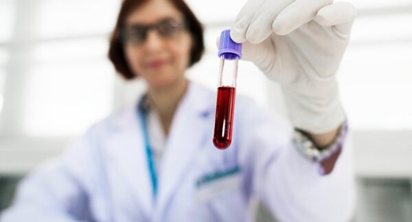 Departamentos de hematología - Hematólogo sosteniendo un tubo de ensayo clínico para diagnosticar enfermedad de la sangre en uno de los mejores departamentos de hematología de Madrid