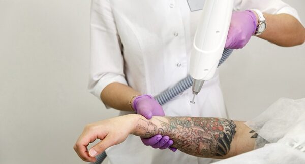Centros de eliminación de tatuajes - Proceso para eliminar tatuajes láser en uno de los mejores centros de eliminación de tatuajes en Madrid