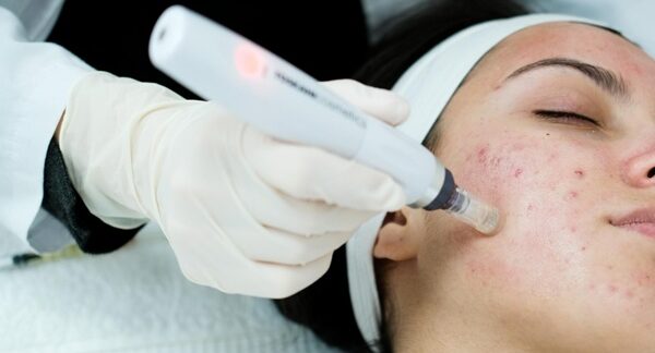 Centros de tratamiento del acné - Dermatólogo realizando un tratamiento para eliminar las marcas de acné y granos en la cara de una mujer joven