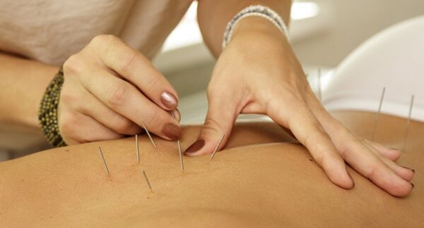 Centros de acupuntura - Acupunturista colocando agujas acupuntura para tratar a un paciente en uno de los mejores centros de acupuntura Madrid