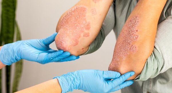 Centros de psoriasis - Médico especialista en enfermedad de la piel atendiendo a un paciente con psoriasis nerviosa en uno de los mejores centros de psoriasis en Madrid
