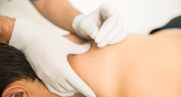 Acupuntores - Mujer en una sesión de acupuntura con el mejor acupuntor en Madrid